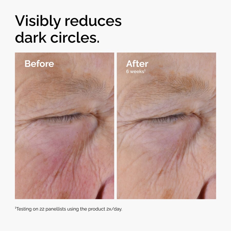 caffeine-solution-5-egcg-eye-serum-d5 ord-caffeine-solution-egcg-dark-circles-before-after.jpg
