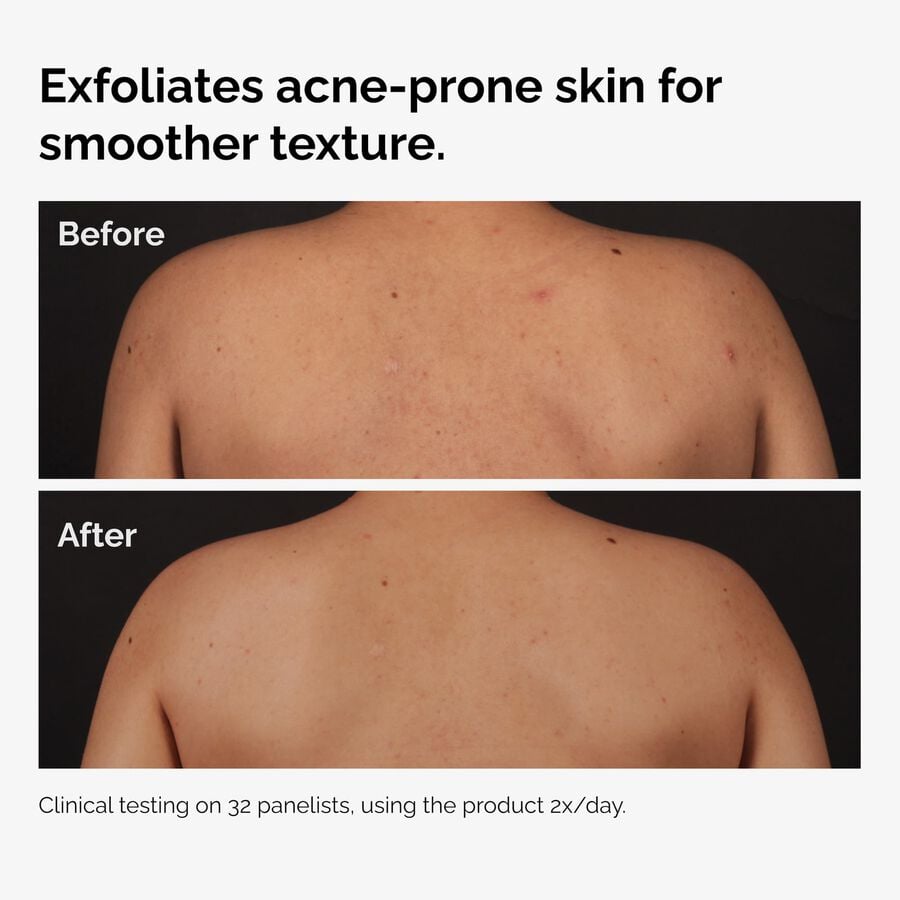 salicylic-acid-0-5-body-serum-n7 ord-salicylic-acid-body-serum-before-after-graphic-NA.jpg